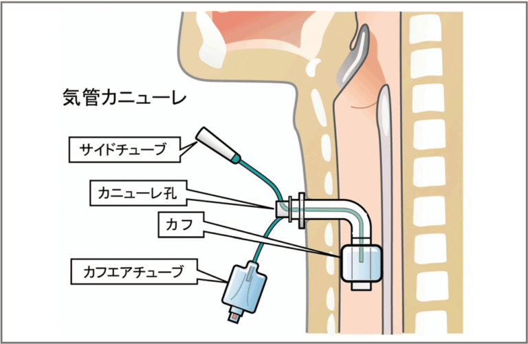 気管切開のカニューレ除去に向けてどのように準備しますか?